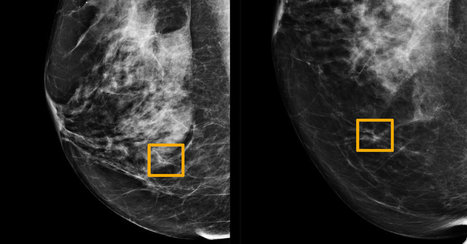 A.I. Is Learning to Read Mammograms | Hospitals and Healthcare | Scoop.it