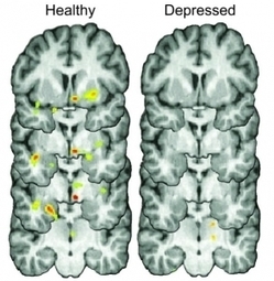 DÉPRESSION: Se secouer? Pas facile quand on est déprimé! | Médecine  Cerveau Intelligence | Scoop.it