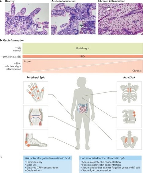 Revisiting the gut&ndash;joint axis: links between gut inflammation and spondyloarthritis | Rheumatology-Rhumatologie | Scoop.it