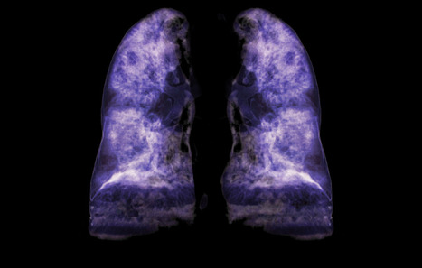 Greffe du poumon : pr&eacute;dire les rejets et dysfonctionnements avec la mol&eacute;cule HLA-G | Life Sciences Universit&eacute; Paris-Saclay | Scoop.it