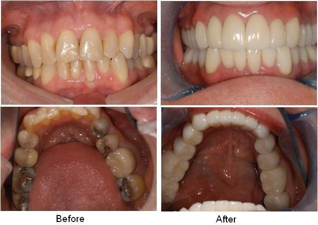 Front Tooth Crown Cost In India