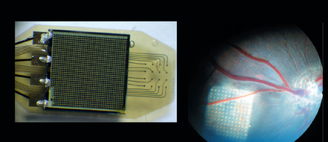 Un implant &eacute;lectronique qui peut redonner acc&egrave;s &agrave; la vue | e-Sant&eacute;, Objets Connect&eacute;, Senior 3.0, Silver Economie, D&eacute;pendance N.0! | Scoop.it
