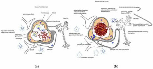 Hemorrhagic Transformation of Ischemic Strokes | Neurovascular Intervention | Scoop.it
