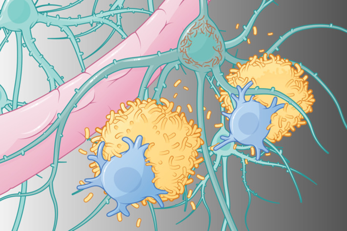 Alzheimer&rsquo;s drugs are finally tackling the disease itself. Here&rsquo;s how | The Health Report | Scoop.it