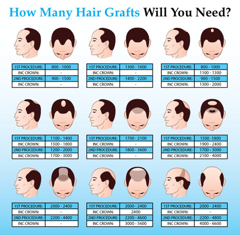 Hair Graft Calculator And Images With Types Of