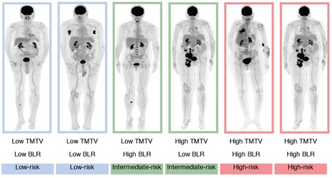 L&rsquo;imagerie TEP-TDM au FDG pr&eacute;-th&eacute;rapeutique pr&eacute;dit la r&eacute;ponse &agrave; l&rsquo;immunoth&eacute;rapie anticanc&eacute;reuse et la survie des patients | Life Sciences Universit&eacute; Paris-Saclay | Scoop.it