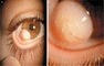 The Hairy Eyeball — Limbal Dermoid — NEJM | Salud Visual 2.0 | Scoop.it