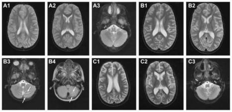 Anti-NMDA-receptor encephalitis in a 3 year old patient with chromosome 6p21.32 microdeletion including the HLA cluster | AntiNMDA | Scoop.it