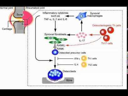 Rheumatoid arthritis – innate and adaptive immune system | 21st Century Innovative Technologies and Developments as also discoveries, curiosity ( insolite)... | Scoop.it