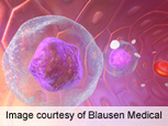 Particular Donor Genotype Lowers Leukemia Relapse Rate - Doctors Lounge | Hematology | Scoop.it