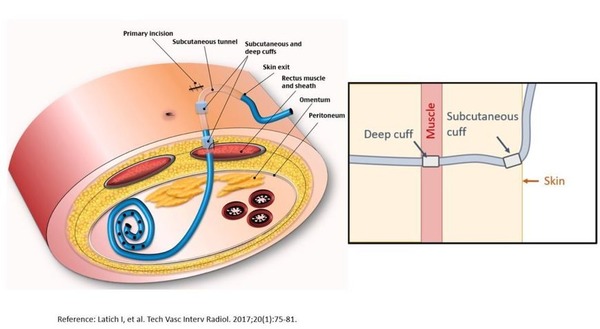 Bedside Ultrasonography of the Peritoneal Dialysis Catheter | Peritoneal dialysis | Scoop.it