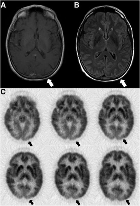Diagnostic Value of 18F-FDG PET/CT Versus MRI in the Setting of Antibody-Specific Autoimmune Encephalitis | AntiNMDA | Scoop.it