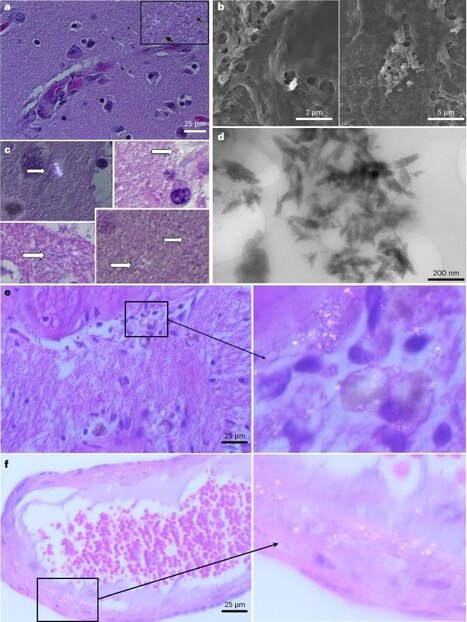 Bioaccumulation of microplastics in decedent human brains. Alessandro J. Nihart, ... - Nature Medicine | One Health News: salute, ambiente e società - A cura di ISDE, Festival della salute, Marketing sociale. N°14 | Scoop.it