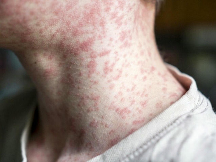 Why are measles cases in Alberta rising faster than in most other provinces? | The Health Report | Scoop.it