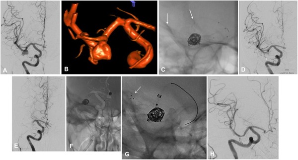 Endovascular strategies for stroke management after subacute in-stent thrombosis | Neurovascular Intervention | Scoop.it