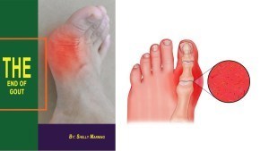 Shelly Manning's The End Of Gout Ebook PDF Download | Ebooks & Books (PDF Free Download) | Scoop.it