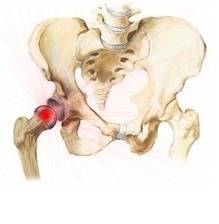 DePuy Hip Replacement Patients: What The Company Doesn't Want You To Know About Your Legal Rights | Nursing Homes Abuse Blog | Rhode Island Personal Injury Attorney | Scoop.it