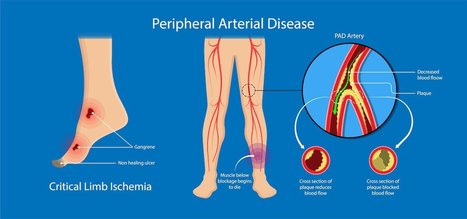 A qualitative study on the experiences of informal caregivers of patients with critical limb-threatening ischemia | Critical Limb-Threatening Ischemia (CLTI) | Scoop.it