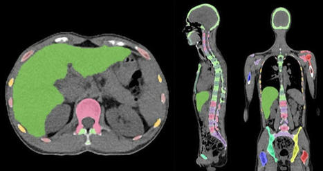 Artificial intelligence could alert for focal skeleton/bone marrow uptake in Hodgkin’s lymphoma patients staged with FDG-PET/CT | healthcare technology | Scoop.it