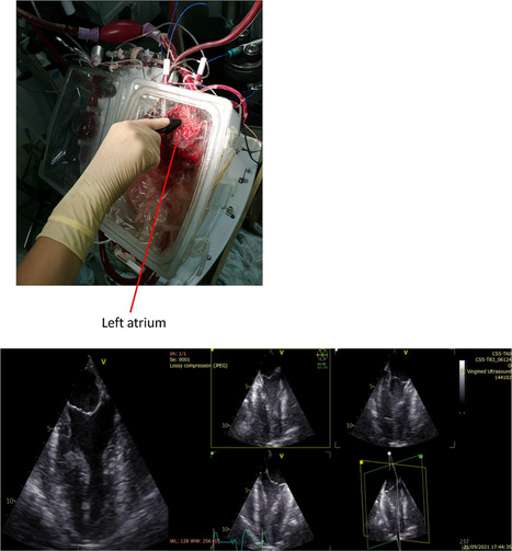 Un indice échocardiographique novateur pour évaluer la fonction cardiaque en perfusion ex situ | Life Sciences Université Paris-Saclay | Scoop.it