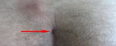 Pilonidal Cyst Definition Causes Symptoms H