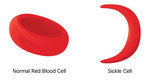 Athletic trainers, medical experts discuss sickle cell trait - The Huntsville Times - al.com | Hematology | Scoop.it