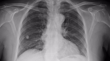 Intelligence artificielle: Un outil de diagnostic du cancer en Chine  | UseNum - Santé | Scoop.it