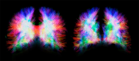 A severe malformation illustrates the incredible plasticity of the human brain | Amazing Science | Scoop.it
