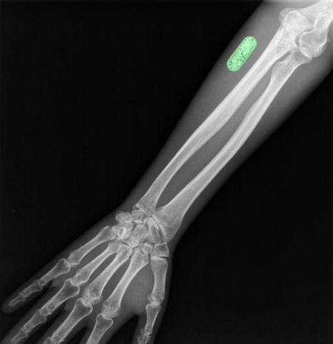 Bionic Yourself, un implant connecté pour suivre sa santé | UseNum - Santé | Scoop.it