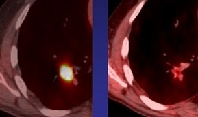 Electrical pulse treatment pokes tiny holes to kill cancer | KurzweilAI | Health Supreme | Scoop.it