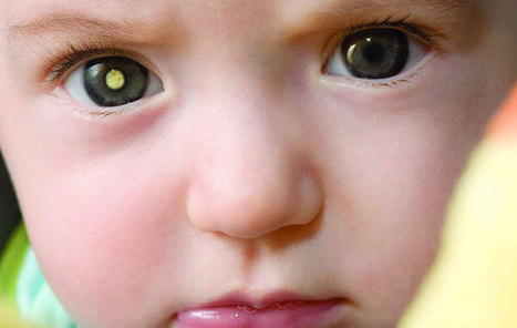 Papiloma y genética multiplican casos retinoblastoma en bebés RD | Salud Visual 2.0 | Scoop.it