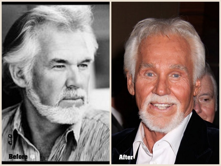 Kenny Rogers Plastic Surgery Before and After P...