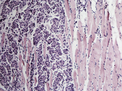 Killing Cancer From the Inside Out | The Health Report | Scoop.it