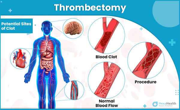 Procedural duration “exerts a greater influence” on post-thrombectomy functional outcomes compared to prehospital delays | Neurovascular Intervention | Scoop.it