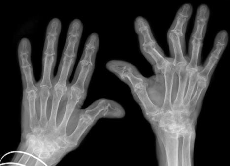 Rheumatoid Arthritis: Understanding the Condition, Symptoms, and Management | Rheumatology-Rhumatologie | Scoop.it