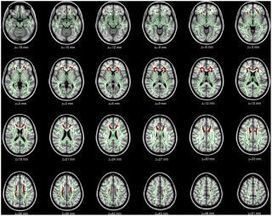 Gray Matters: Too Much Screen Time Damages the Brain // Dr. Victoria Dunckley | Screen Time, Tech Safety & Harm Prevention Research | Scoop.it