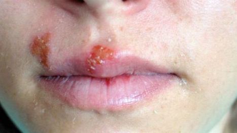 Cara Mengobati Herpes Di Bibir Dan Mulut Secara