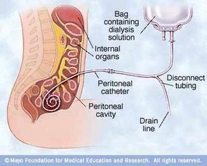 Introduction to Peritoneal Dialysis Services | Peritoneal dialysis | Scoop.it