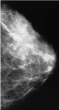 CDC - Hoja informativa sobre las mamografías | Salud Publica | Scoop.it