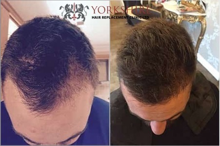 Regain Strong Thick Hair Conveniently By