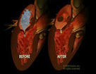 Aortic Valve Replacement That Doesn't Require Open Heart Surgery - Science Daily (press release) | Transcatheter Treatment of Mitral Regurgitation | Scoop.it