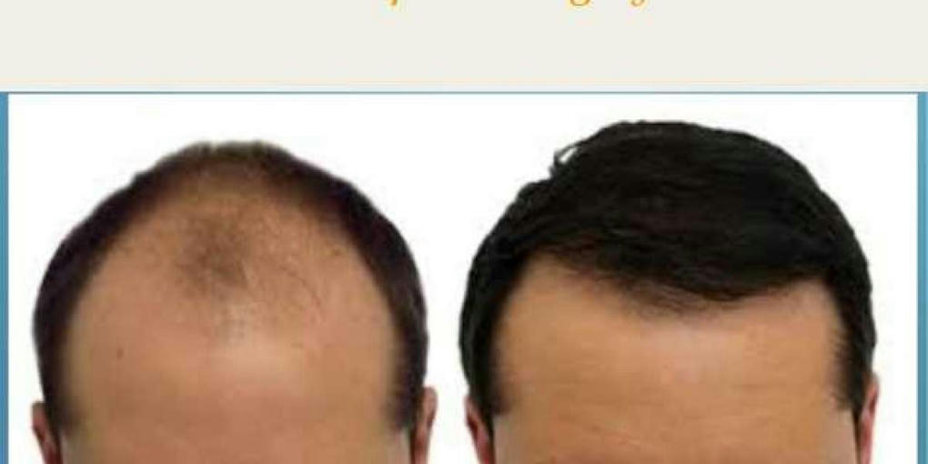 How Long Do Hair Restoration Last? hair and b...