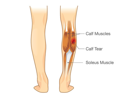 Calf Pain: Plantaris Tendon Rupture | El Paso Back Clinic&reg; &bull; 915-850-0900 | Sports Injuries | Scoop.it