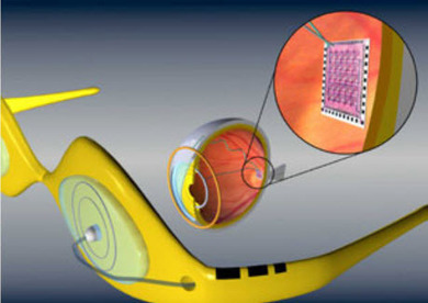 Artificial retina receives FDA approval | KurzweilAI | Longevity science | Scoop.it