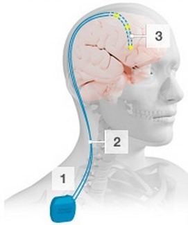 Deep brain stimulation may hold promise for mild Azheimer’s disease | KurzweilAI | Longevity science | Scoop.it