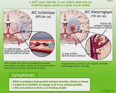 Thromboinflammation dans l&rsquo;accident vasculaire c&eacute;r&eacute;bral isch&eacute;mique - Vers de nouvelles opportunit&eacute;s th&eacute;rapeutiques ? | m&eacute;decine/sciences | Neurovascular Intervention | Scoop.it