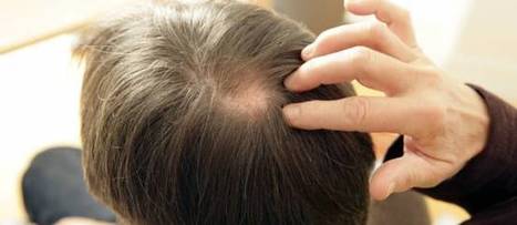 Calvitie : des chercheurs ont trouvé le moyen de faire repousser des cheveux | Mais n'importe quoi ! | Scoop.it