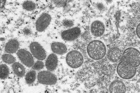 Epidémie de mpox : la RDC va homologuer en urgence deux vaccins et un traitement | sida | Scoop.it