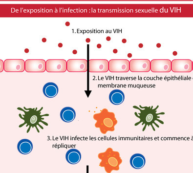 Quel rôle jouent les IST dans la transmission du VIH ? | CATIE | sida | Scoop.it