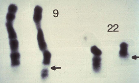 Gleevec: the Breakthrough in Cancer Treatment | Learn Science at Scitable | Hematology | Scoop.it